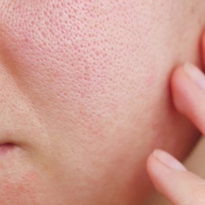 Enlarged Pores/Skin Texture