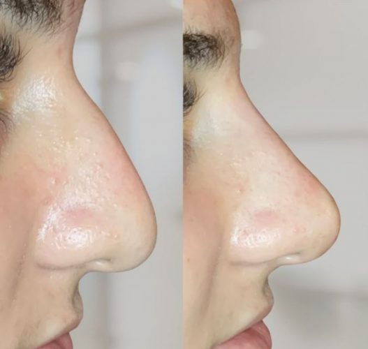 Nose contouring